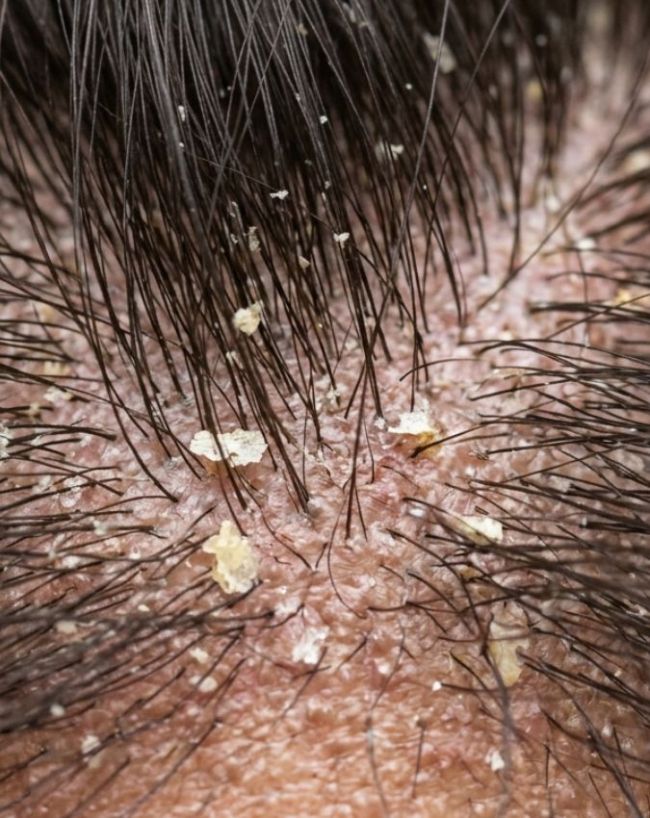 Vitamin D Deficiency Signs On Hair-1-2-3-4-5