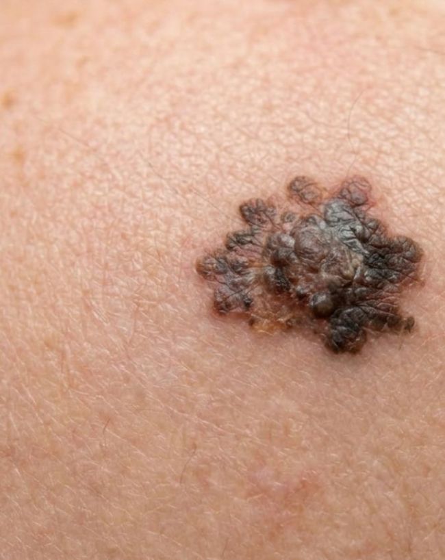 7 Warning Signs Of Cancer-1-2-3-4-5