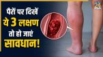 Blood Clots In Legs