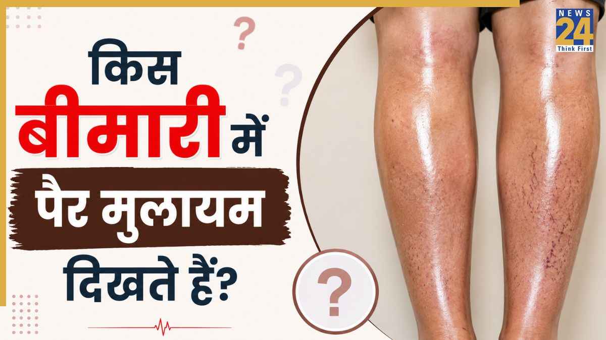 टांगों का मुलायम और चमकदार नजर आना हो सकता है इस बीमारी का संकेत, वैस्कुलर सर्जन ने किया एक्सप्लेन