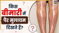 टांगों का मुलायम और चमकदार नजर आना हो सकता है इस बीमारी का संकेत, वैस्कुलर सर्जन ने किया एक्सप्लेन
