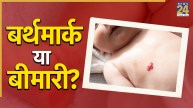 बच्चे के शरीर का निशान बर्थमार्क है या किसी बीमारी का मार्क? डॉक्टर ने बताया कब करानी चाहिए जांच