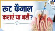 Root Canal Treatment