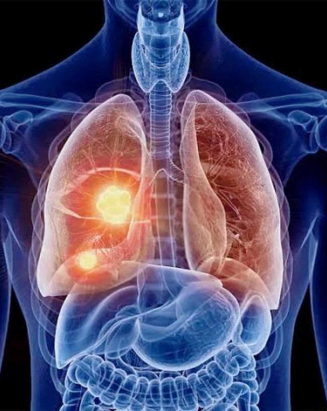 is air purifier good for lung cancer-1-2-3-4