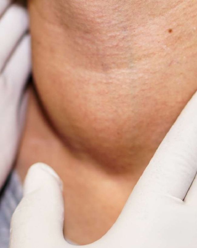 Throat Cancer Symptoms-1-2-3-4-5-6