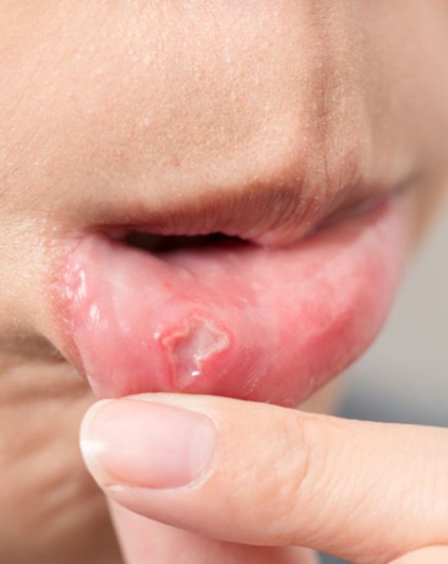 Mouth ulcers-1-2-3