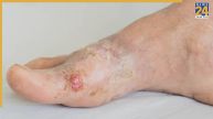 Nerve Damage in Diabetes