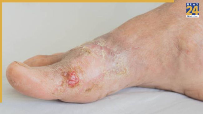Nerve Damage in Diabetes