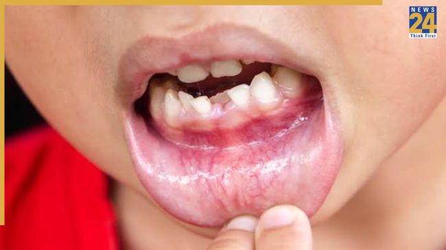 Gum Cancer Symptoms