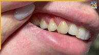 What Age Do Adults Start Losing Teeth: