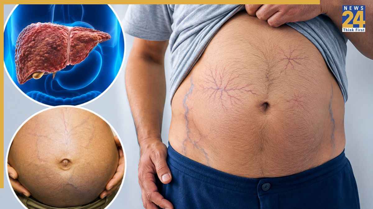 Liver Disease