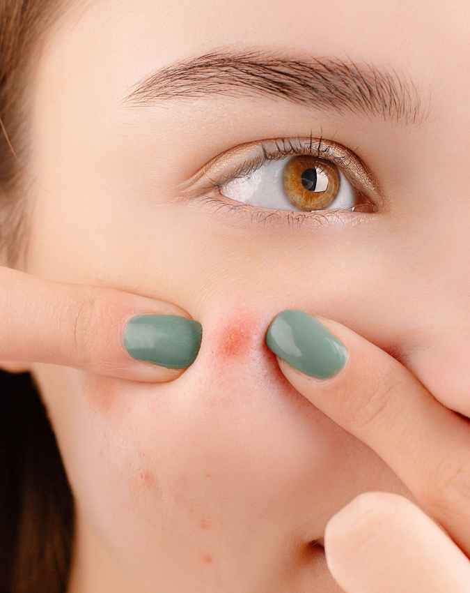 चेहरे पर क्यों निकलते हैं पिंपल्स?