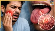 Oral Cancer Early