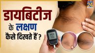 Diabetes Ke Lashan