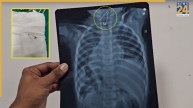 Toddler Swallowed Safety Pin, Surat news, Surat police, Surat New Civil Hospital, Gujarat