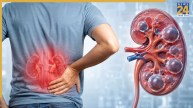 Kidney Cyst