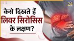 Liver Cirrhosis