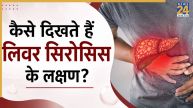Liver Cirrhosis