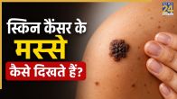 Early Signs Of Skin Cancer