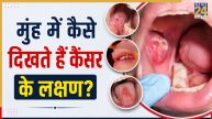 Oral Cancer Signs