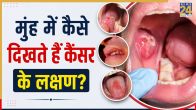Oral Cancer Signs