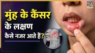 Oral Cancer Signs
