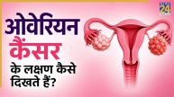 Ovarian Cancer