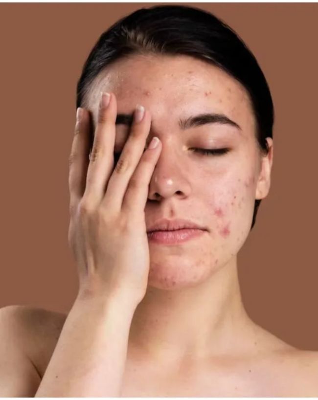 Mouth Ulcers-1-2-3-4-5-6