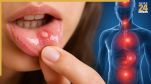 Mouth Ulcers