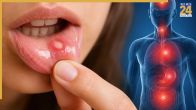 Mouth Ulcers