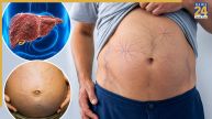 Liver Disease