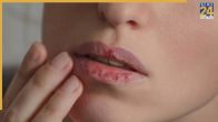 Monsoon Special For Dry Lips