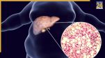 Best drink for fatty liver aiims doctor explain