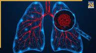 lung cancer non smoker survival rate