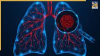 lung cancer non smoker survival rate