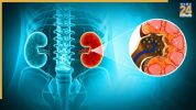 kidney stone patient cannot eat these 5 foods