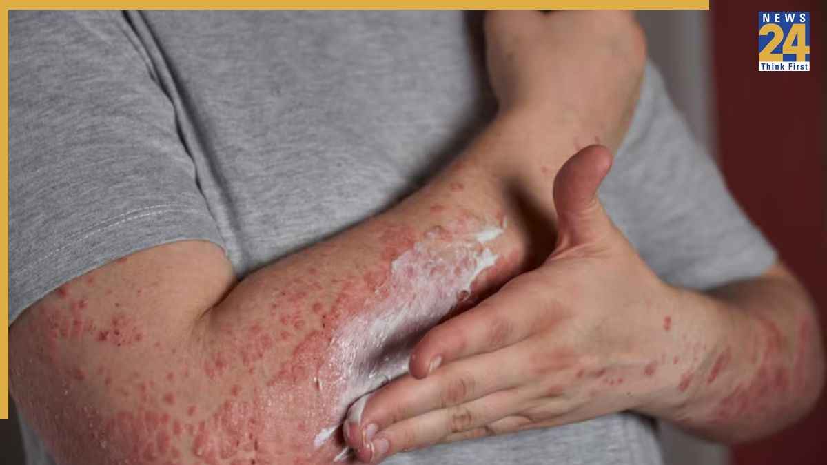 Skin Infection: दाद, खाज और खुजली कर रही है परेशान? राहत दिलाने का काम करेंगे ये आयुर्वेदिक नुस्खे