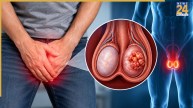 Testicular Cancer