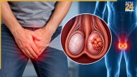 Testicular Cancer