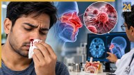 Nasal and Sinus Cancer