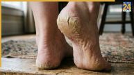 Cracked Heels Home Remedies