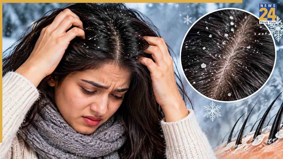 सर्दी आते ही सिर में क्यों बढ़ जाती है रूसी? जानिए Dandruff के कारण और इससे छुटकारा पाने के आसान तरीके