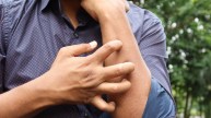 Itching in Liver Disease