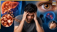 Wilson Disease Symptoms And Diagnosis