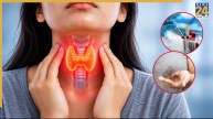 Hypothyroidism