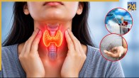 Hypothyroidism