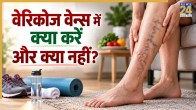 Varicose Veins Treatment