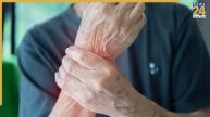 Arthritis Symptoms