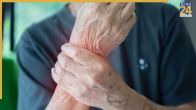 Arthritis Symptoms