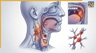 Head And Neck Cancer